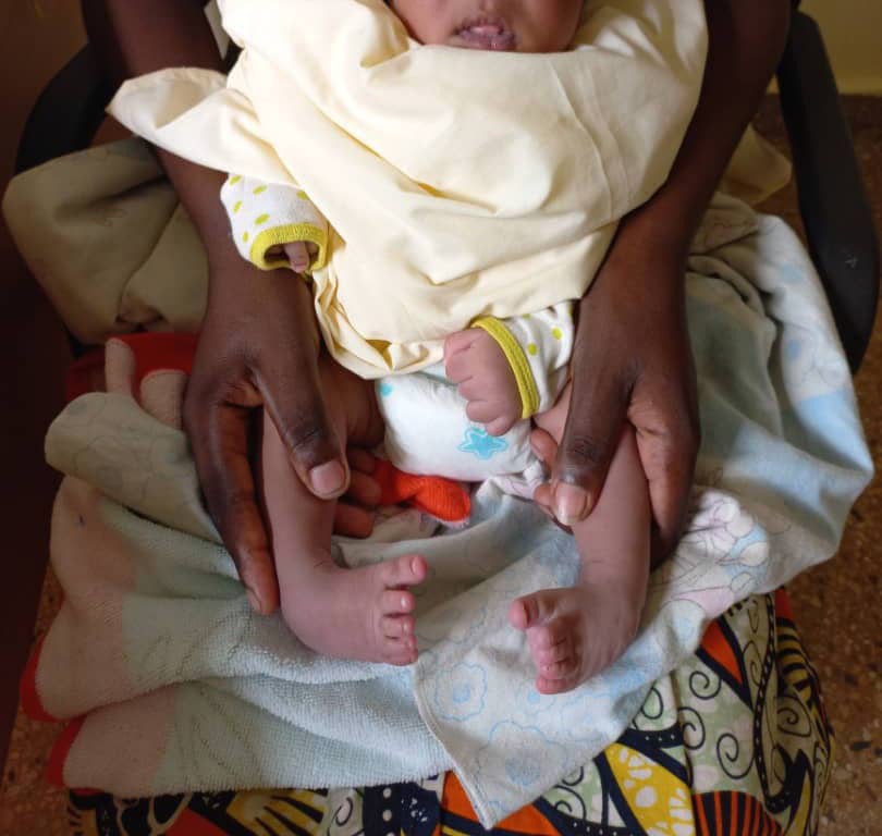 Hope Walks Rwanda iributsa Ababyeyi ko indwara ya Clubfoot ivurwa igakira iyo uwayivukanye avujwe hakiri kare