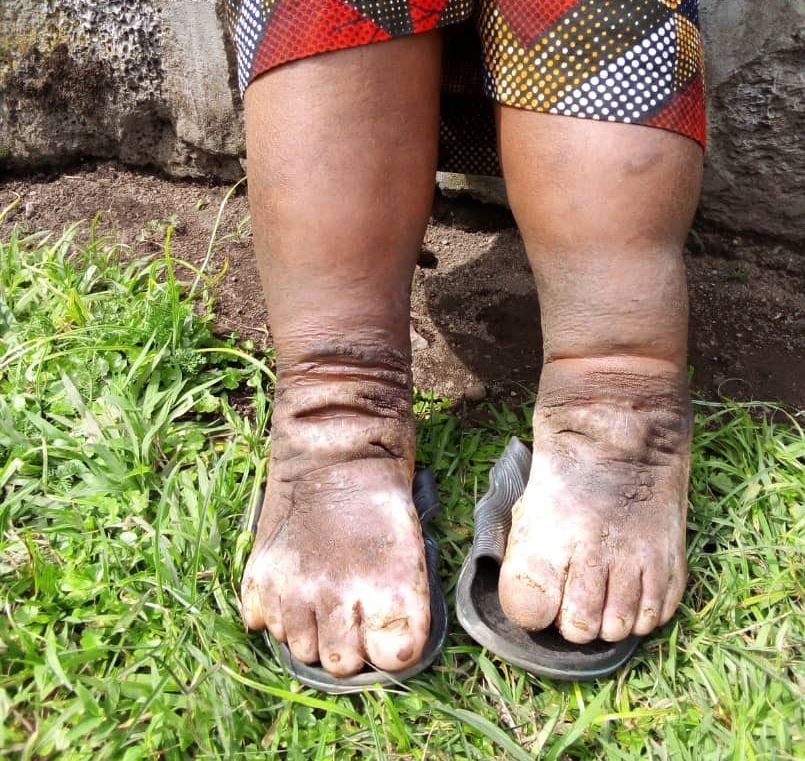 Tumenye indwara y’imidido,ibiyitera  n’uko twayirinda